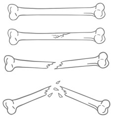 Bone, Broken and Fractured Clipart Set - Colored
