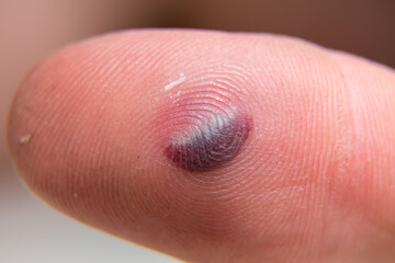 Blood blister under the thumb skin. Caucasian young man finger on white background.