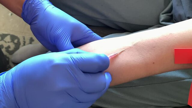 Hands in blue gloves insert IV needle into patient's antecubital vein