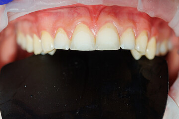 Close-up of teeth, dental checkup in the dental office. The dentist examines the patient's teeth with dental instruments. Dentistry. selective focus