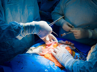 A team of surgeons performing abdominal surgery on a patient to remove a cancerous tumor in the intestines. Selective focus. Hands of surgeons during surgery on the abdominal cavity of a person. - obrazy, fototapety, plakaty