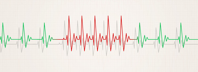 sudden pulse arrhythmia medical illustration