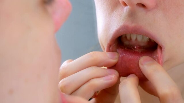 Stomatitis in woman's mouth after dental treatment, disease in the mouth. Stomatitis on the lower lip. Large ulcers in the mouth under the lower teeth. Woman is looking at mirror.