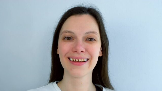 Portrait of young woman with yellow bad teeth laughing looking at camera. Teeth sharpened by a dentist before installing crowns and ceramic veneers. Dentistry treatment, prosthetics of teeth concept.