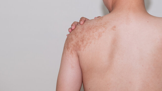 An asian man has a birthmark on the back of the shoulder.