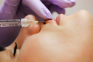Cosmetic procedure. Process of lip augmentation for a woman. A cosmetologist is wearing purple rubber gloves injecting a hyaluronic acid-based filler into patient's lips. Beauty injection process