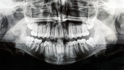 A panoramic shot of the teeth of a teenage girl. Correction with a bracket system is required. It is necessary to expand the jaw on the right side.