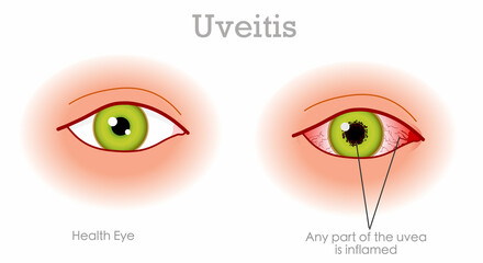 Uveitis anterior diagram. Pink, red infection eye symptoms. Bleeding, acute, inflammation uvea eyes. Normal, health, green iris eye. Ophthalmology medical draw. Graphic illustration vector