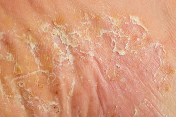 severe pustular psoriasis lesions on the sole of the foot