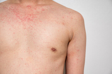 Naklejka premium Dermatitis rash viral disease with immunodeficiency on body of young adult asian, scratch with itch