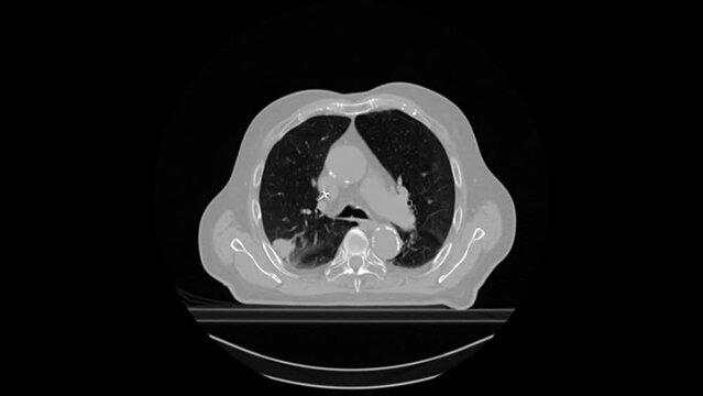 The upper body ct scan of a male patient reveals a subpleural lung tumor in the patient's right posterior upper lobe