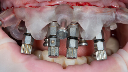 Mounted Dental Implants through a special template