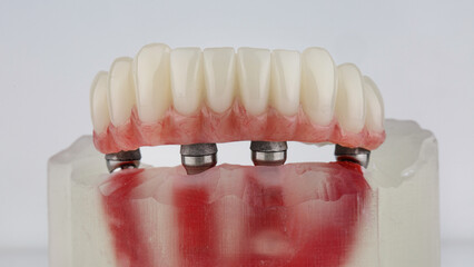 Dental Lower Jaw Prosthetic With Pink Gum on Metal Beam on White Background
