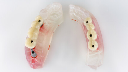 Two temporary bridge dentals on models, top view on white background