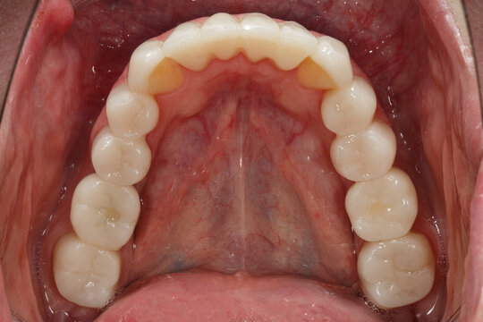 Dental crowns of the lower jaw after prosthetics, photos through the mirror