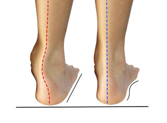 Boy's feet with flat feet or fallen arch, ankle lean inward causing leg length difference. The red...
