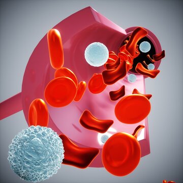 Thalassemia, illustration
