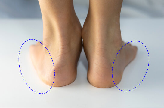 Compared flat foot shape with normal foot shape.