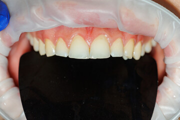 Close-up of teeth, dental checkup in the dental office. The dentist examines the patient's teeth with dental instruments. Dentistry. selective focus