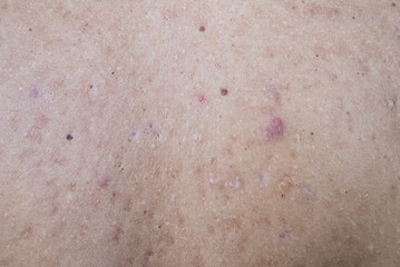 Pimples on the skin. Acne. Sore skin with pimples close-up