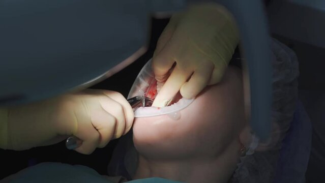 real. dentist pulls out a sick wisdom tooth. 
