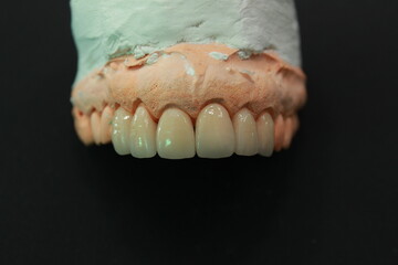 Veneers and crowns by dental technicians try-in the dental models before handing over to the patient insertion dentist.