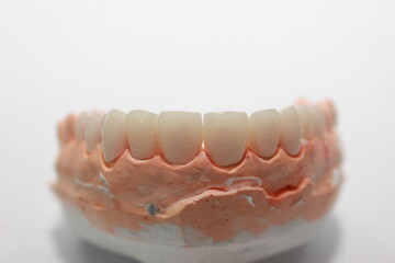 Veneers and crowns by dental technicians try-in the dental models before handing over to the patient insertion dentist.