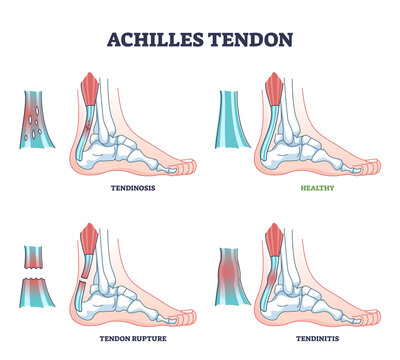 Achilles tendon injury as leg or ankle trauma outline diagram. Labeled educational inflammation and orthopedic ligament conditions vector illustration. Tendinosis, rupture and tendinitis problem.