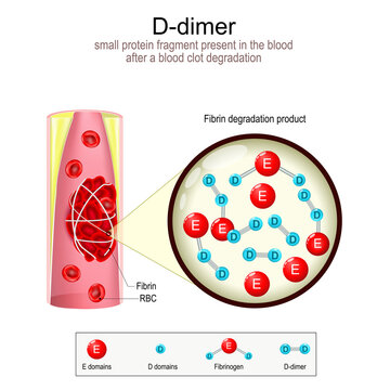 D-dimer formation. Blood vessel with blood clot.