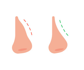 Correction of profile of nose line, changing nasal shape during rhinoplasty surgery. Hump nose and straight nose. Vector illustration