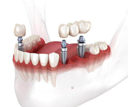 Dental bridge and crown placement over implants. Dental 3D illustration concept