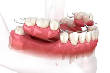 Removable partial denture, mandibular prosthesis. Medically accurate 3D illustration of prosthodontics concept - 483343380