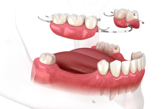 Removable partial denture, mandibular prosthesis. Medically accurate 3D illustration of prosthodontics concept