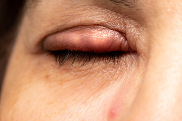Fototapeta premium Woman eye with stye in her eyelid