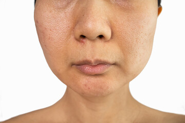 Close-up of woman half face with problems of acne inflammation (Papule and Pustule) on her face. Conceptual of problems on woman skin. skin with enlarged pores.