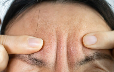 Close-up Woman's face with wrinkles on her forehead. The concept of collagen and facial injections. Menopause. Cropped image. Copy space and simulate.