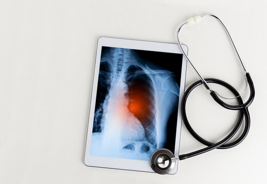 A tablet with an x-ray of a lung and a stethoscope on a table in a hospital
