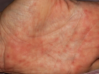 detail of scarlet fever in an adult caucasian man