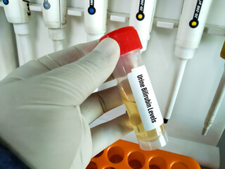 Hand holding blood sample in vacuum tube for pathological analysis. Various laboratory disease...