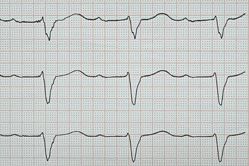 Elektrokardiogramm mit einem AV-Block ersten Grades