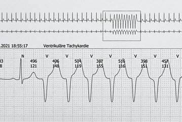 Kurze ventrikuläre Tachycardie in einem Langzeit-EKG - obrazy, fototapety, plakaty