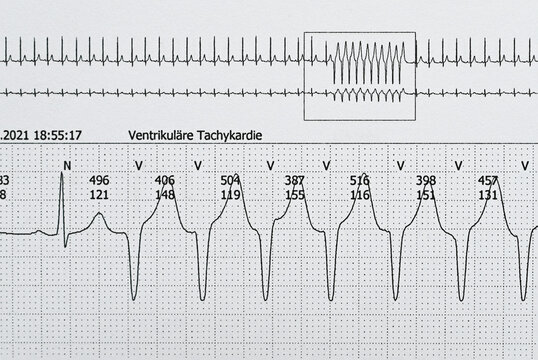 Kurze ventrikul&auml;re Tachycardie in einem Langzeit-EKG