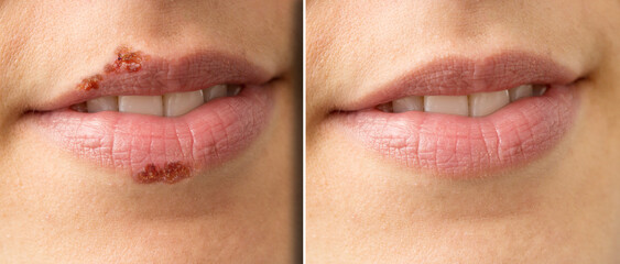 Macro of a woman's lips before and after herpes treatment - obrazy, fototapety, plakaty