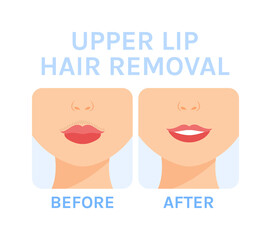 Female Mustache. Removal of Unwanted Hair above Lip. Depilation. Before After. Clean Skin and Smile on Face. Cartoon Color style. White background. Vector illustration for Beauty Cosmetology design.