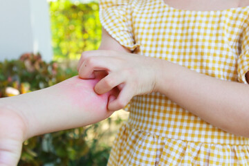 Little girl has skin rash allergy and itchy on her arm