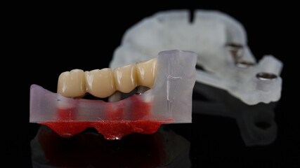 dental bridge prosthesis on chewing teeth against the background of a surgical template on a black...