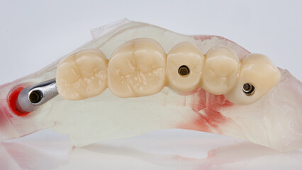 dental prosthesis for five teeth on a white background
