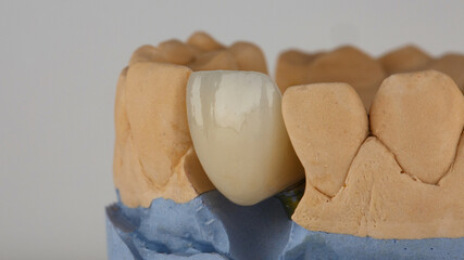 beautiful view of the ceramic crown of the central tooth on the model