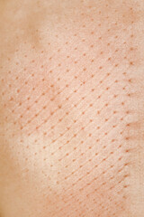 skin print on back after extreme yoga training - relaxation and self-development - laying on the Sadhu board with nails