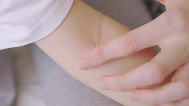 mom applies the ointment to dermatitis on the bend of the elbow in a little girl